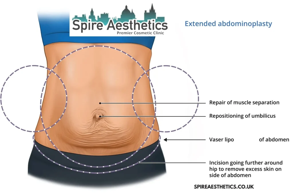 Understanding Loose Skin After Gastric Band Wednesbury Surgery and HIFU Treatment