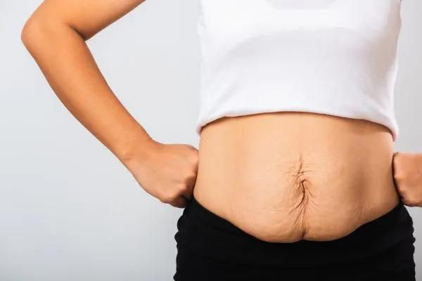 Image of a woman's stomach after weight loss with sagging skin following a gastric band Wednesbury