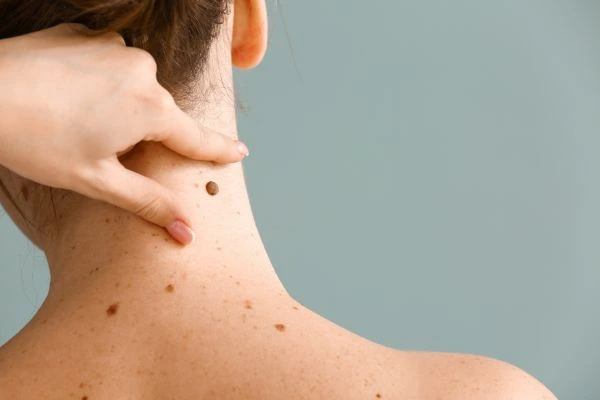 skin blemish removal Wednesbury treatment