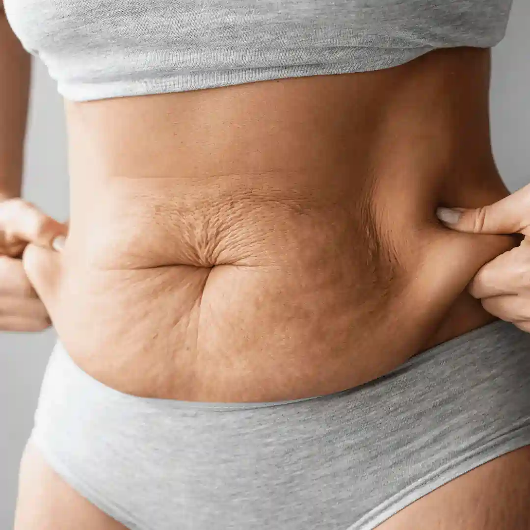 Is It Normal to Have Loose Skin After Pregnancy Wednesbury?